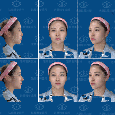 法喬醫美診所_3D模擬+下巴斷層掃描模擬