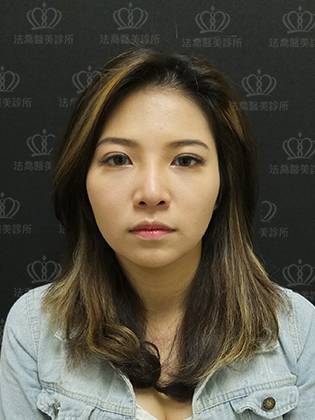 法喬醫美診所客製化骨水泥墊下巴