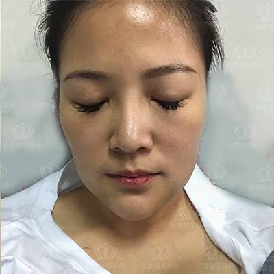 法喬醫美診所_骨水泥墊下巴術後第二天有些微瘀青