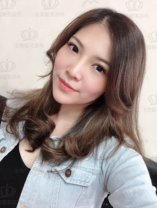 法喬醫美診所_骨水泥墊下巴