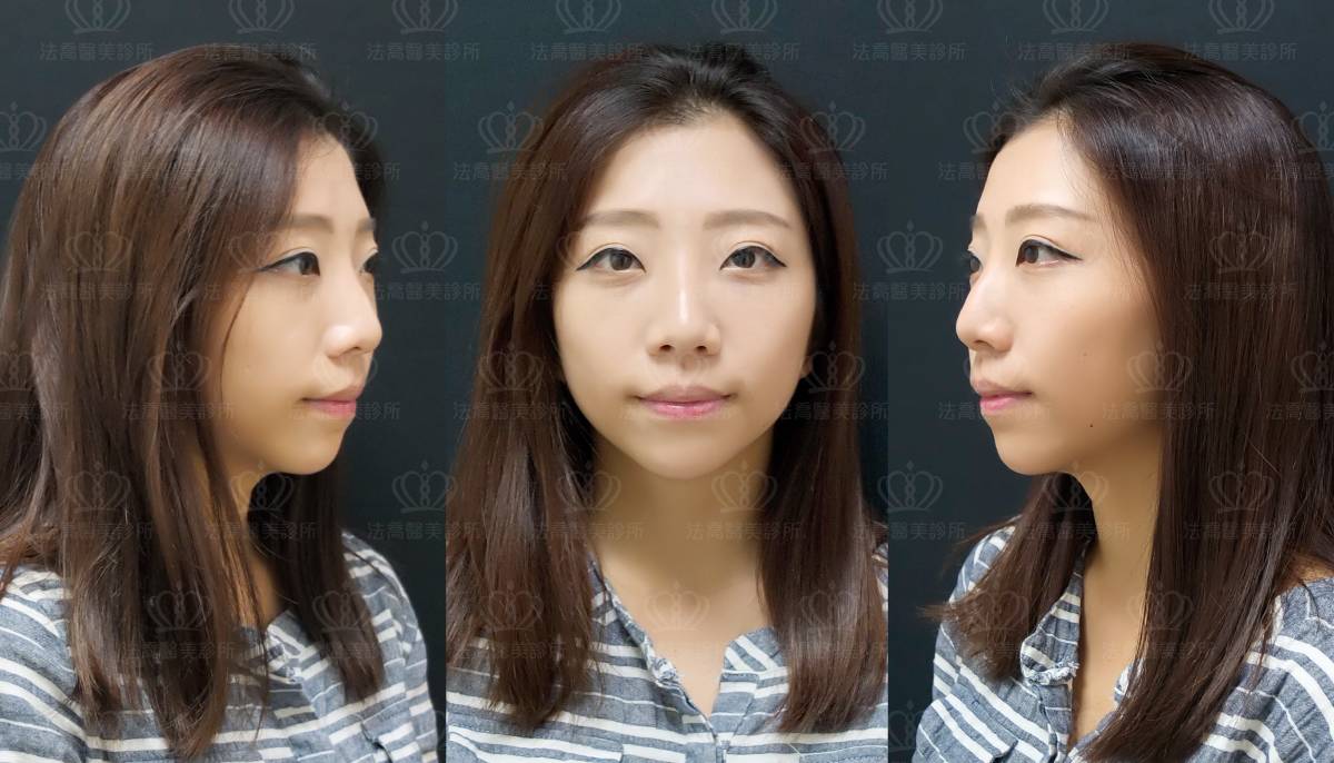 雙眼皮