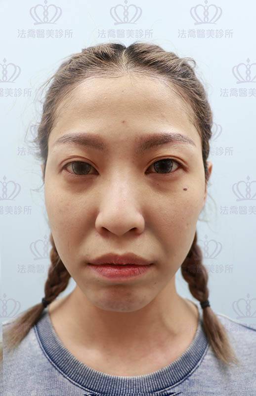 法喬醫美診所_微整術前照