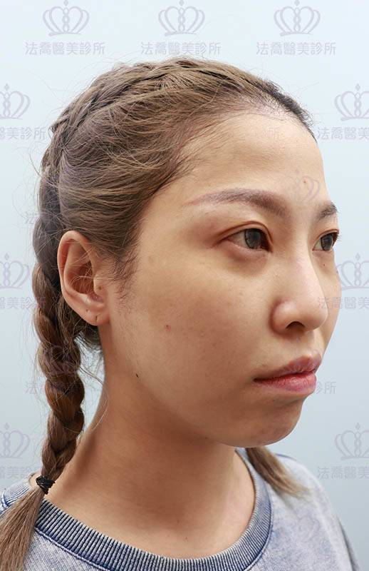 法喬醫美診所_微整術前照