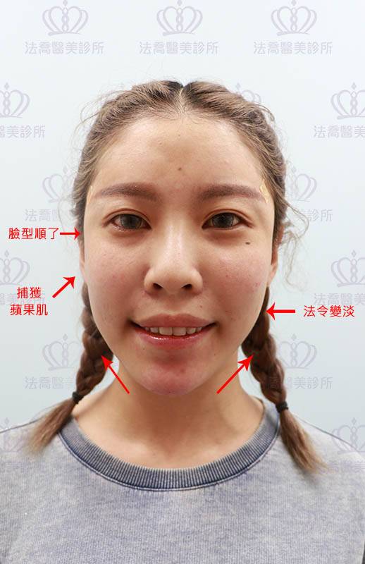 法喬醫美診所_Ellanse洢蓮絲當天術後