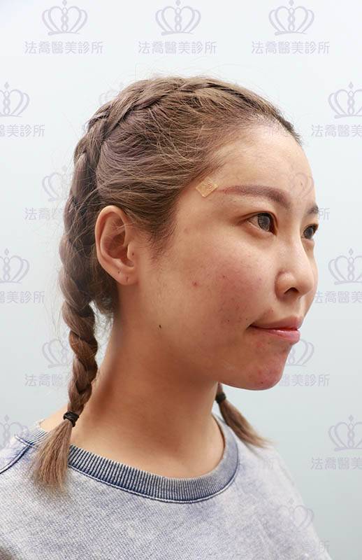 法喬醫美診所_Ellanse洢蓮絲當天術後