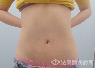 法喬術後45天BA圖