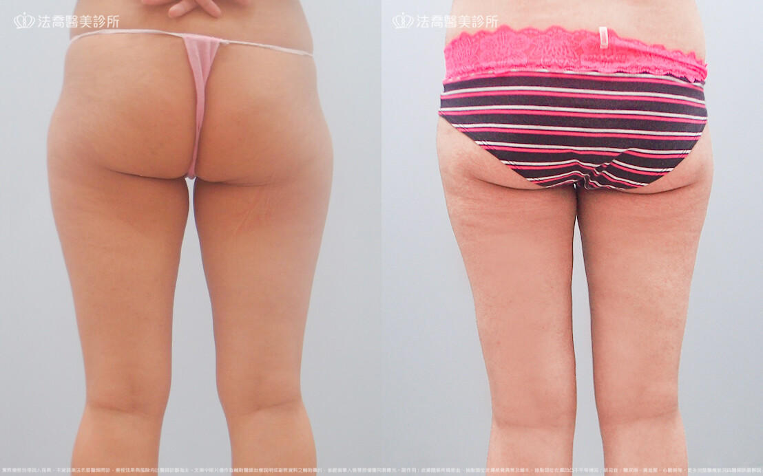 法喬醫美診所,邱浚彥,威塑大腿環抽