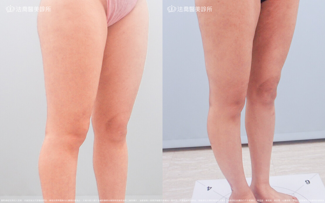 法喬醫美診所,邱浚彥,威塑大腿環抽