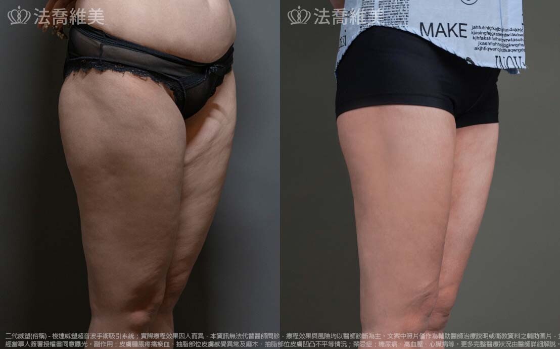 法喬醫美診所,邱浚彥,威塑抽脂