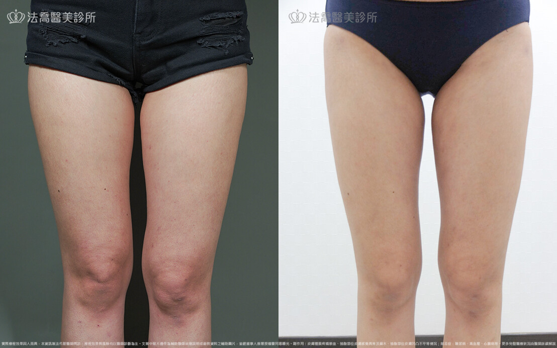 大腿抽脂