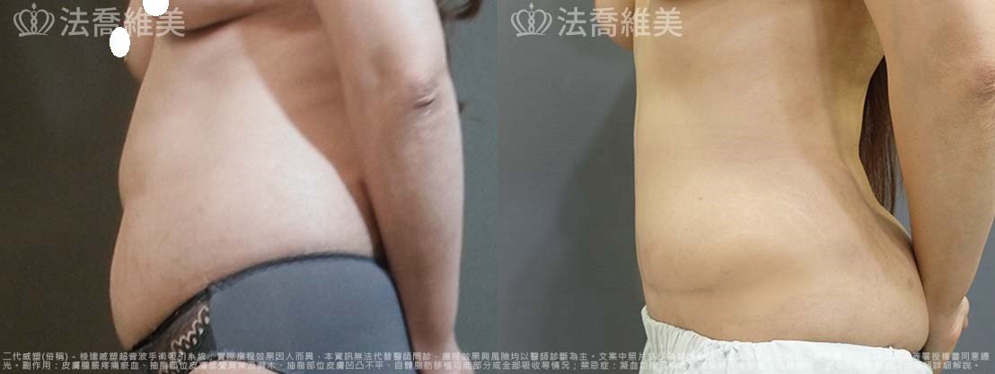 腹部環抽