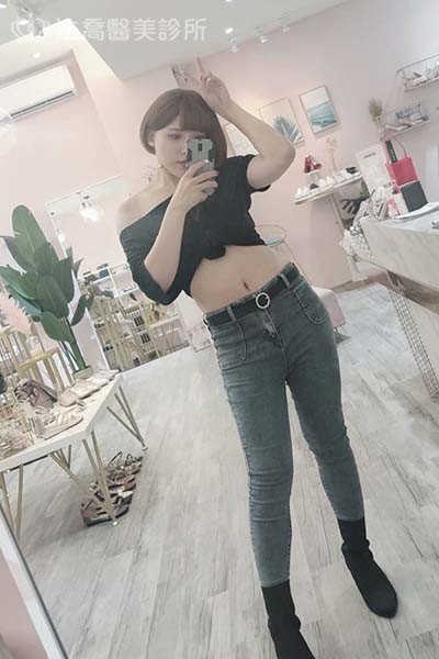 自體肋骨隆鼻