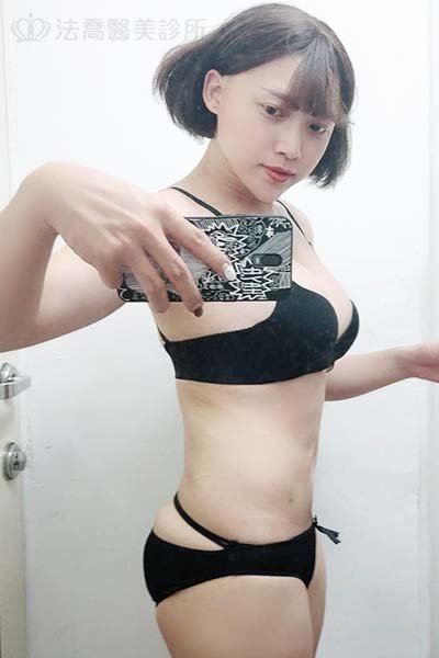 自體肋骨隆鼻