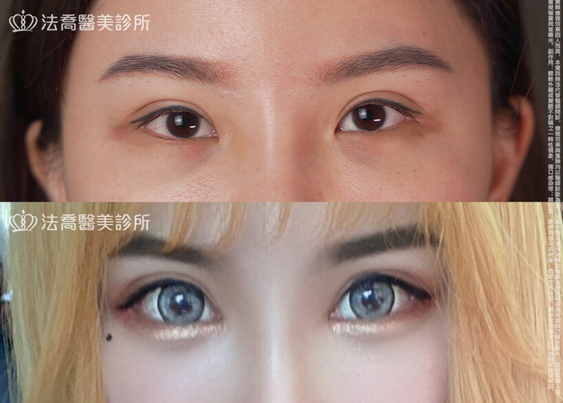 開眼頭、開眼尾、眼尾下置術