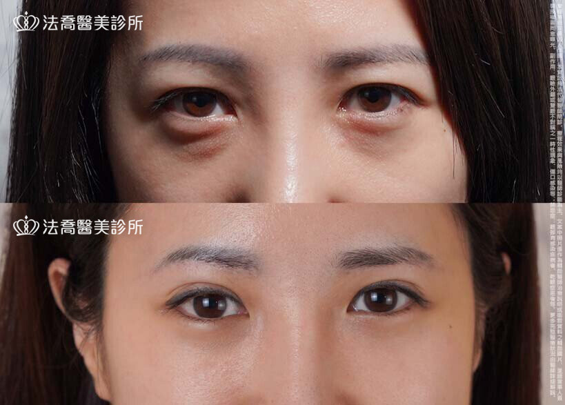 法喬醫美診所,邱浚彥醫師,眉下切皮,切眉