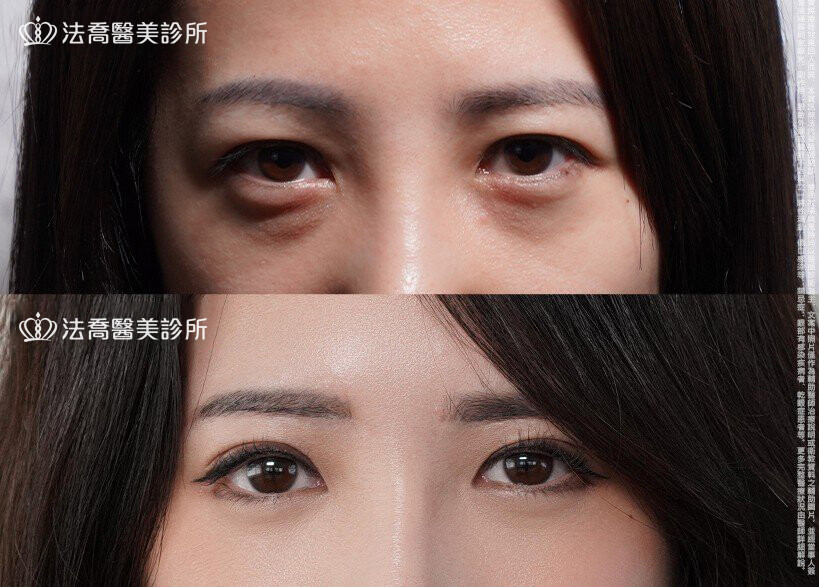 眼袋內開、切眉 / 術前與術後6個月
