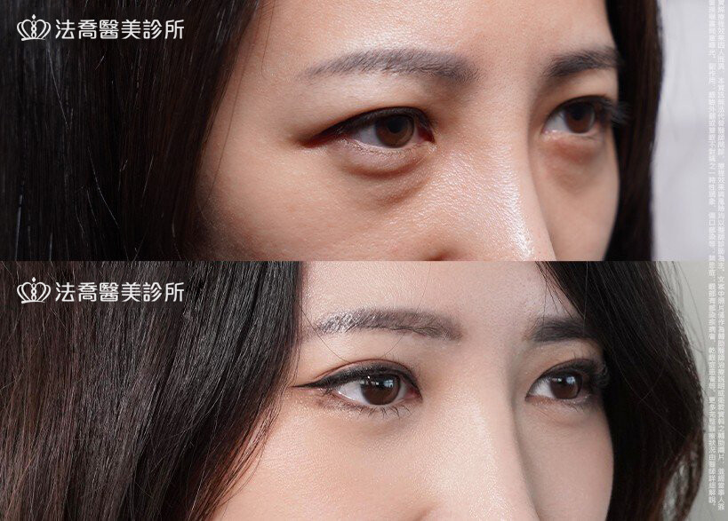 眼袋內開、切眉 / 術前與術後6個月