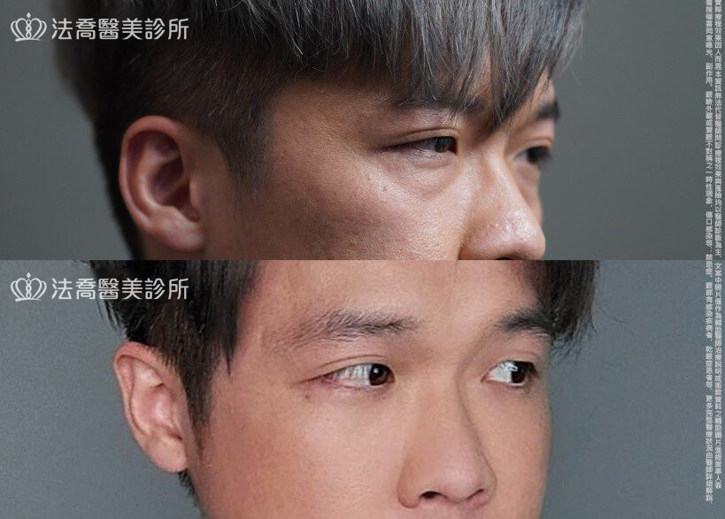 眼袋內開、脂肪移位  術前與術後1個月