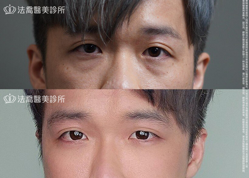 眼袋內開、脂肪移位  術前與術後1個月