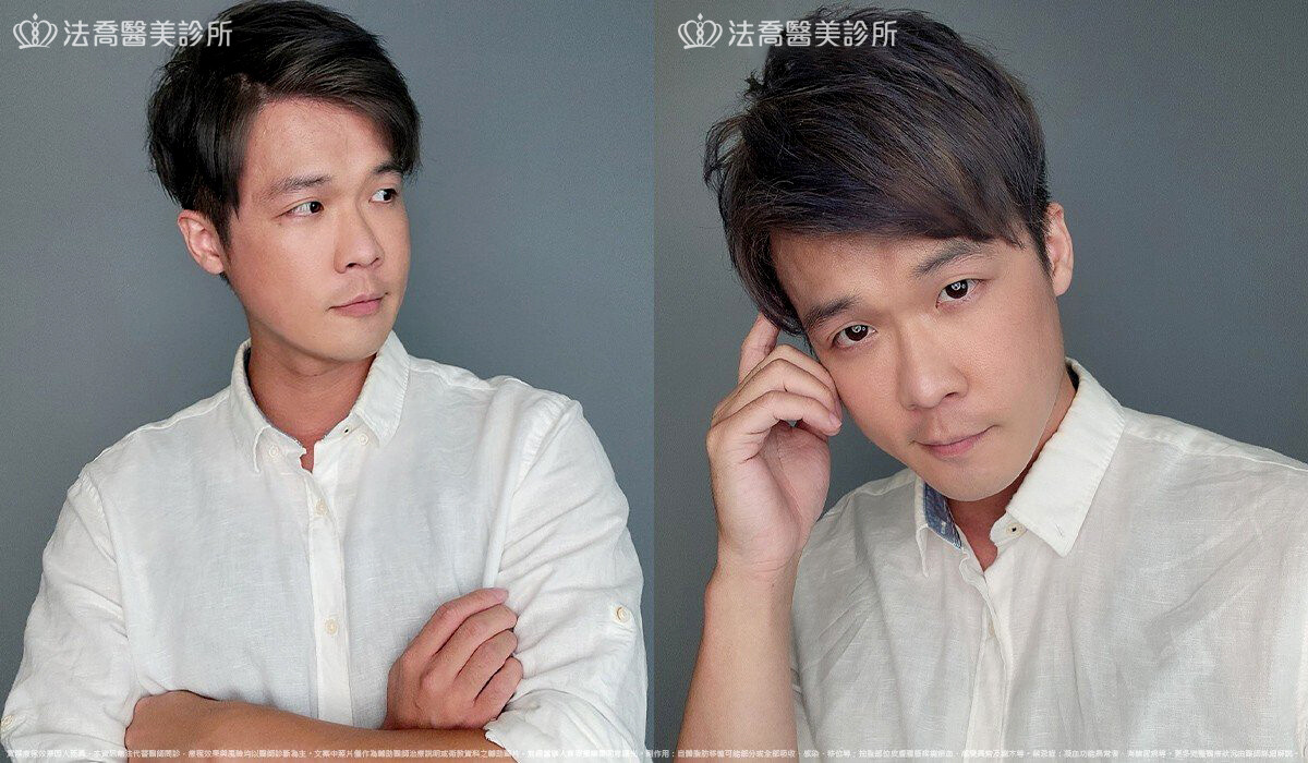 眼袋內開 脂肪移位  術後一個月 生活照