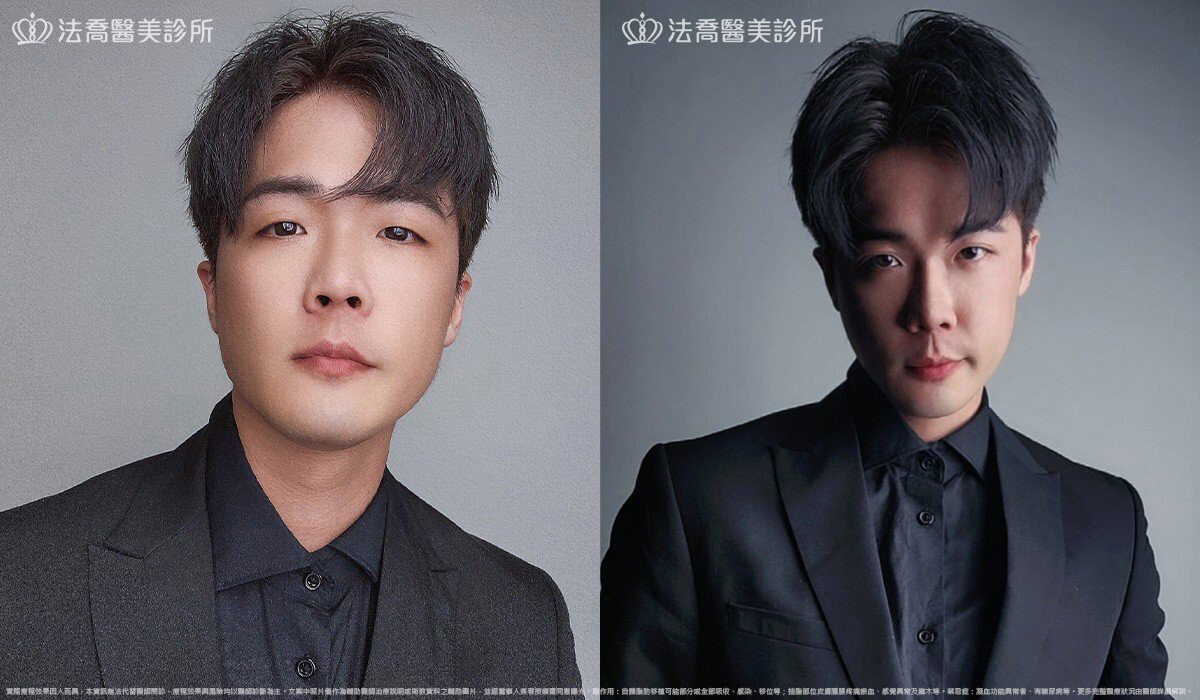 眼袋內開、脂肪移位  術後3個月