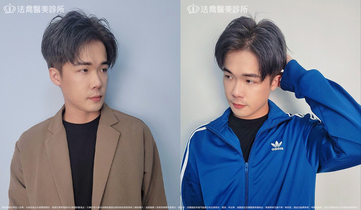 眼袋內開、脂肪移位 / 術後3個月