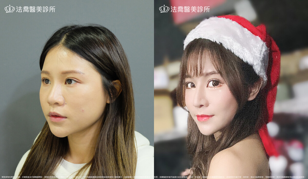 法喬醫美診所,邱浚彥,自體肋骨隆鼻
