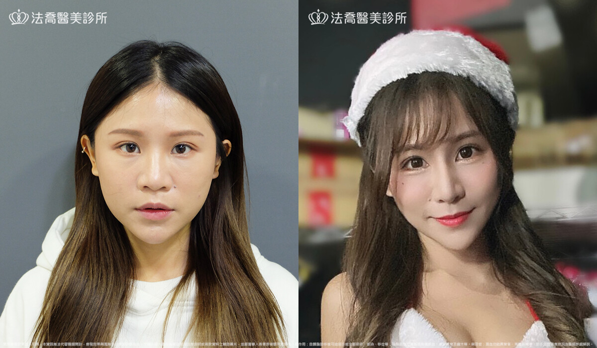 法喬醫美診所,邱浚彥,自體肋骨隆鼻