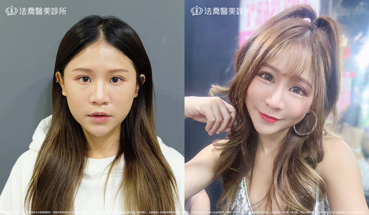 法喬醫美診所,邱浚彥,自體肋骨隆鼻