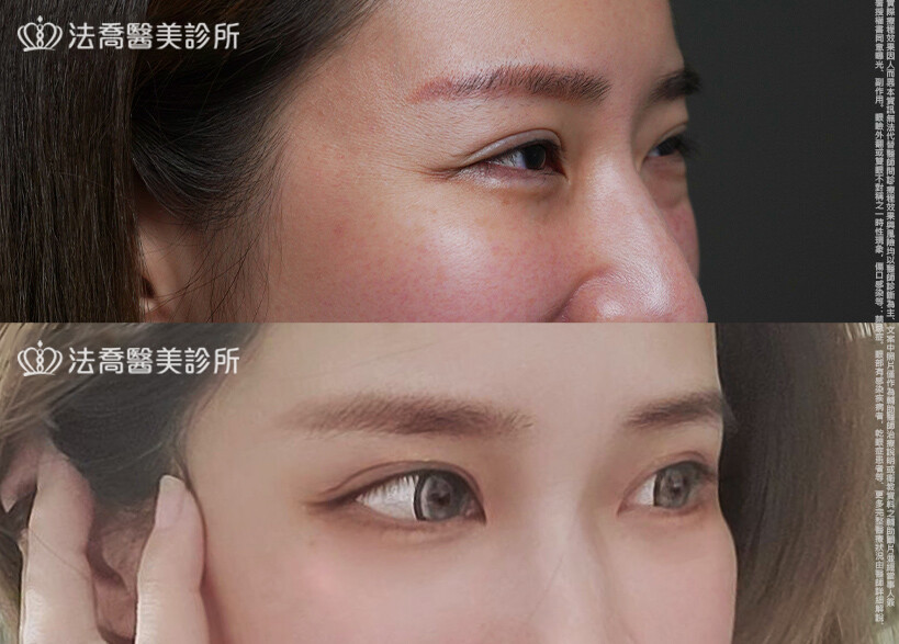 眼袋內開、脂肪移位  術前與術後1個月