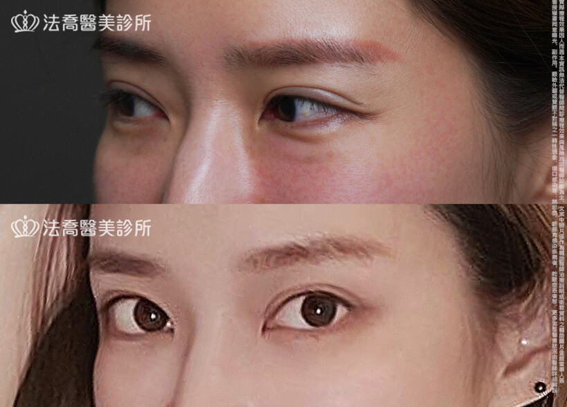 眼袋內開、脂肪移位  術前與術後1個月