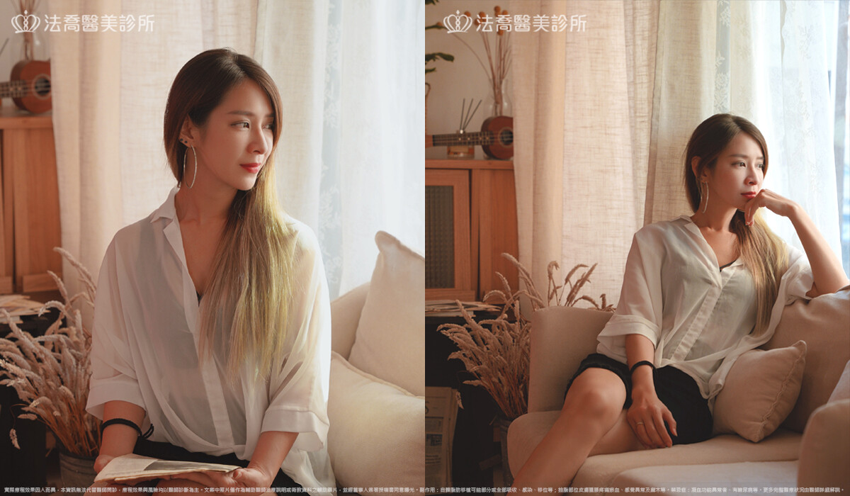 眼袋內開、脂肪移位  術後4個月