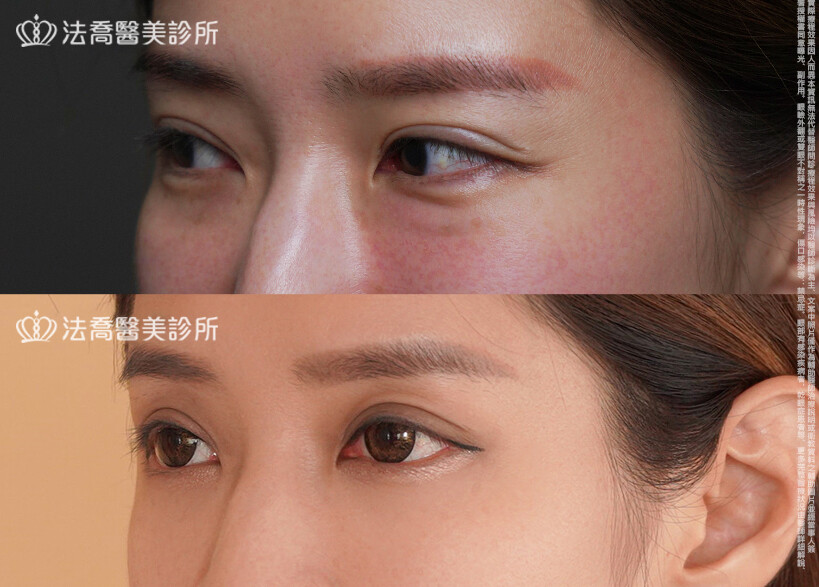 眼袋內開、脂肪移位  術前與術後3個月