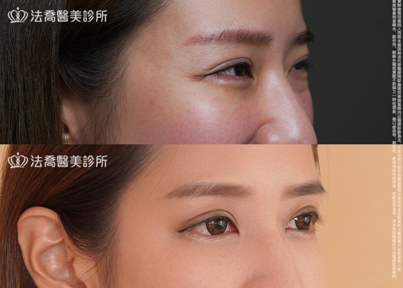 眼袋內開、脂肪移位  術前與術後3個月