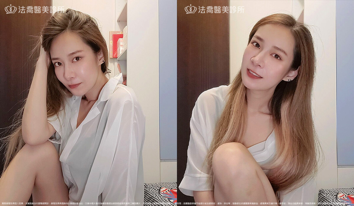 眼袋內開 脂肪移位  術後一個月 生活照