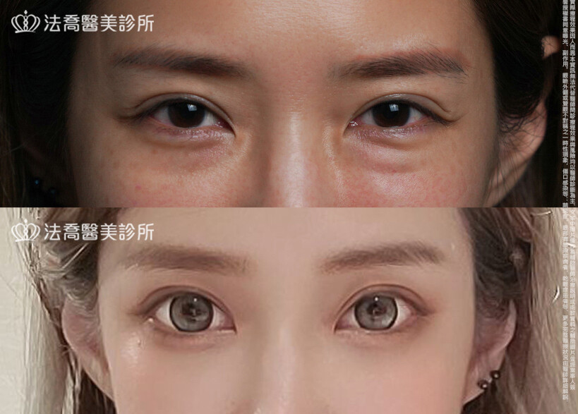 眼袋內開、脂肪移位  術前與術後1個月