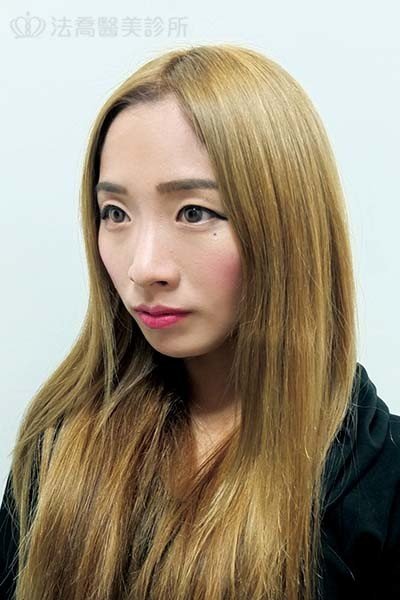 自體肋骨隆鼻