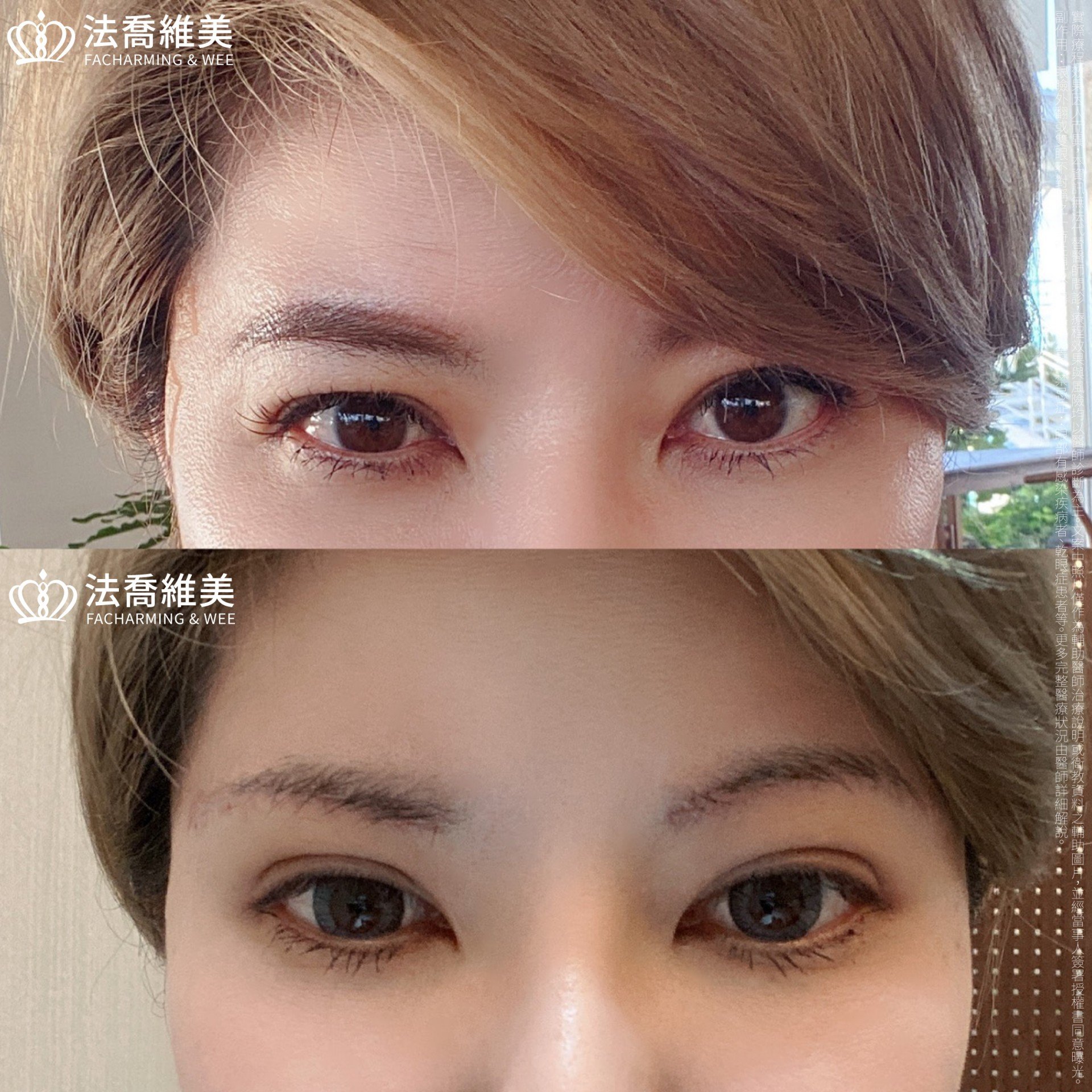 法喬醫美診所,邱浚彥醫師,眉下切皮,切眉