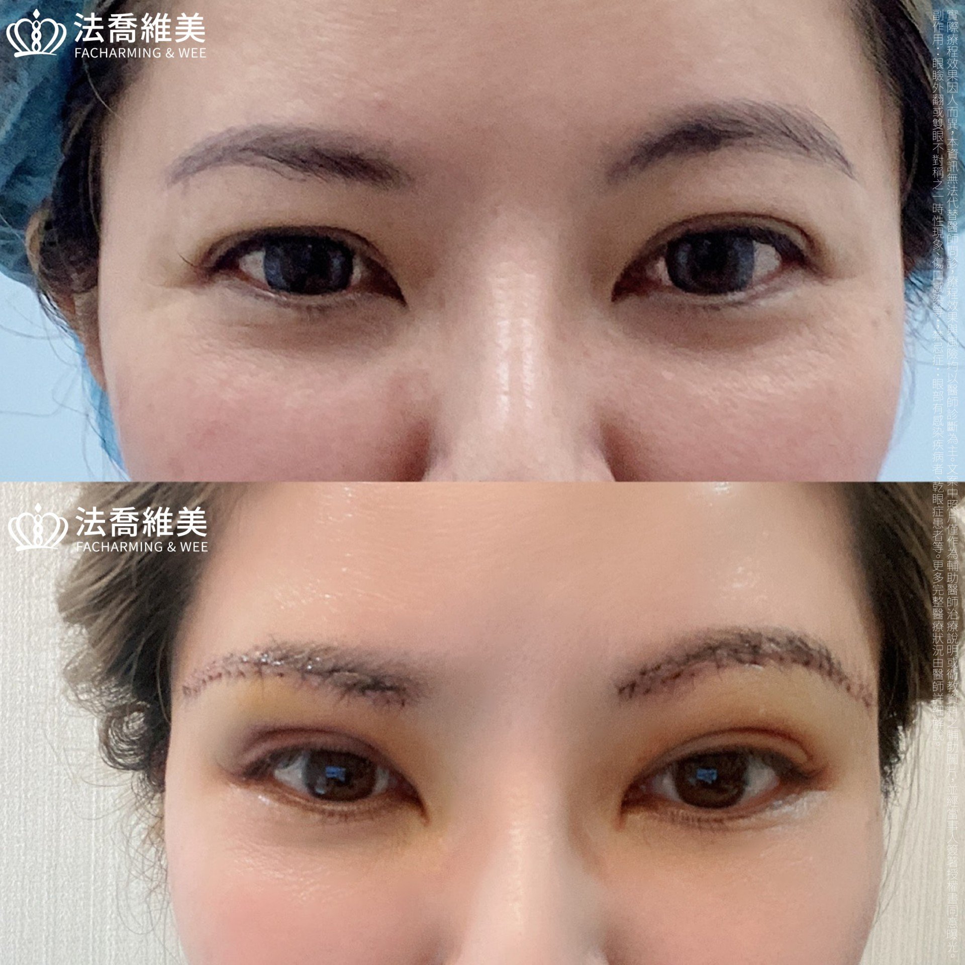 法喬醫美診所,邱浚彥醫師,眉下切皮,切眉