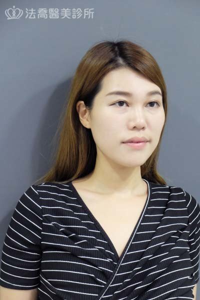 自體肋骨隆鼻