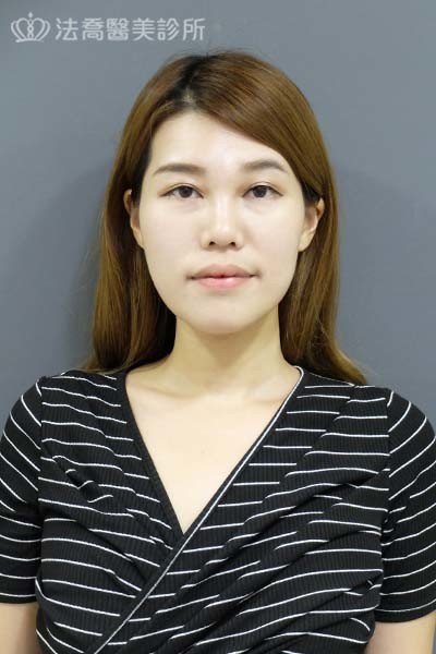 自體肋骨隆鼻
