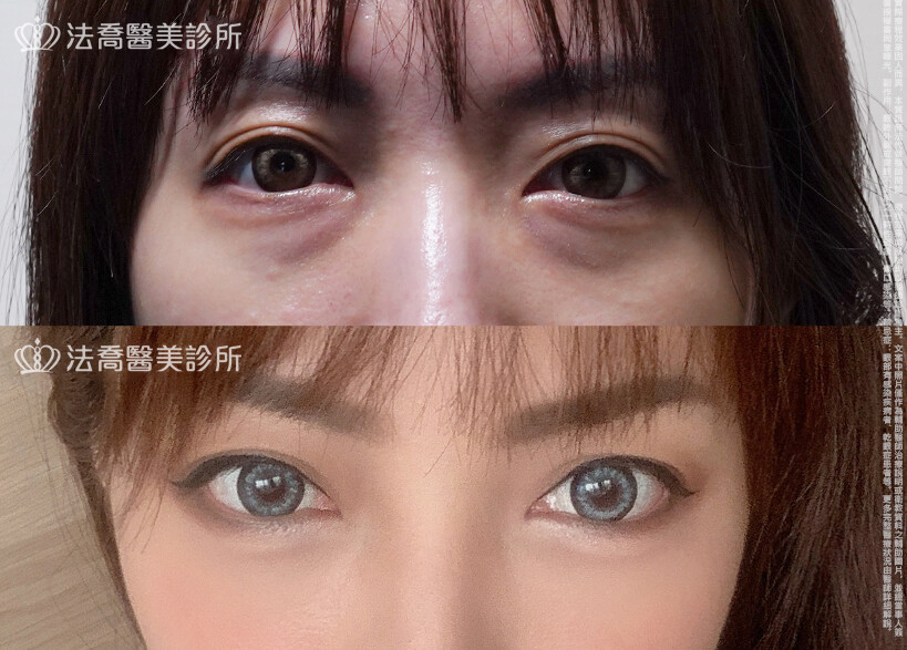 眼袋內開、脂肪移位 術前與術後1個月