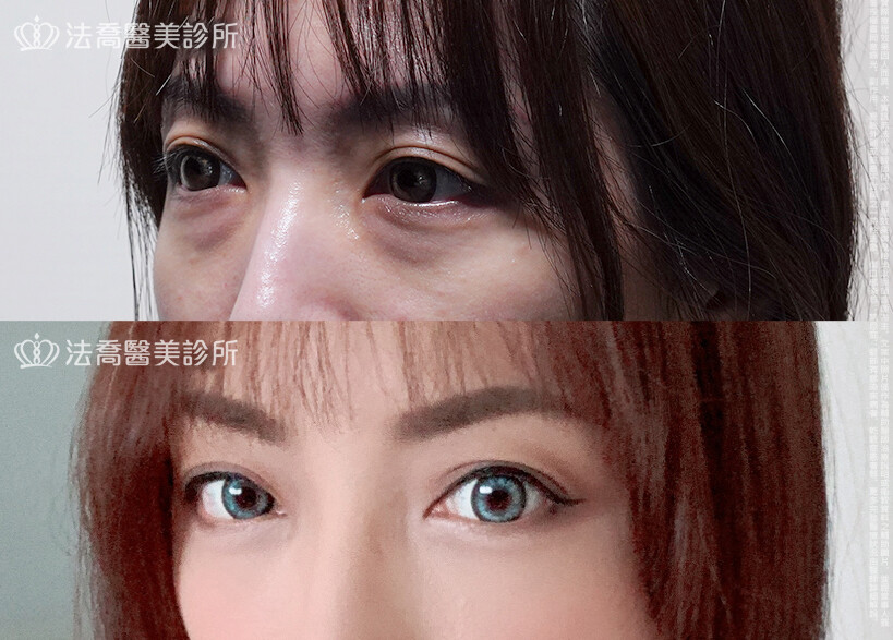眼袋內開、脂肪移位 術前與術後3個月