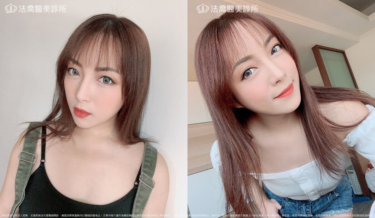 眼袋內開、脂肪移位 / 術後3個月