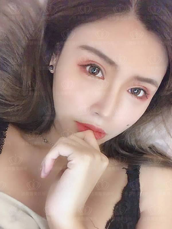 法喬醫美診所_割雙眼皮合併提眼瞼肌+開眼頭開眼尾+眼尾下置