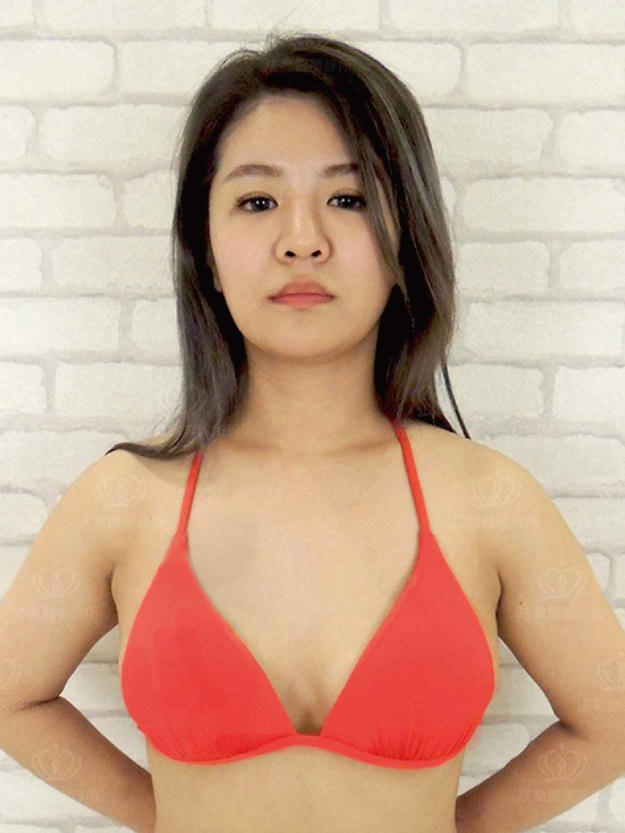 威塑,自體脂肪隆乳,抽脂,抽脂補胸,果凍隆乳