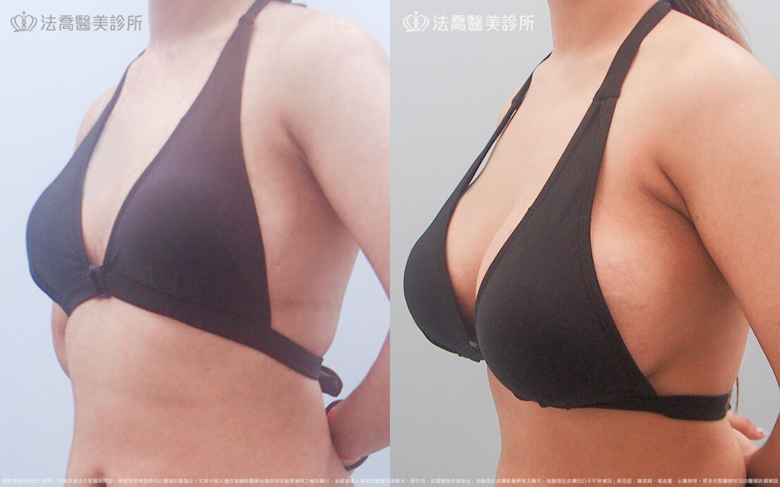 法喬醫美診所,邱浚彥,超音波複合式隆乳