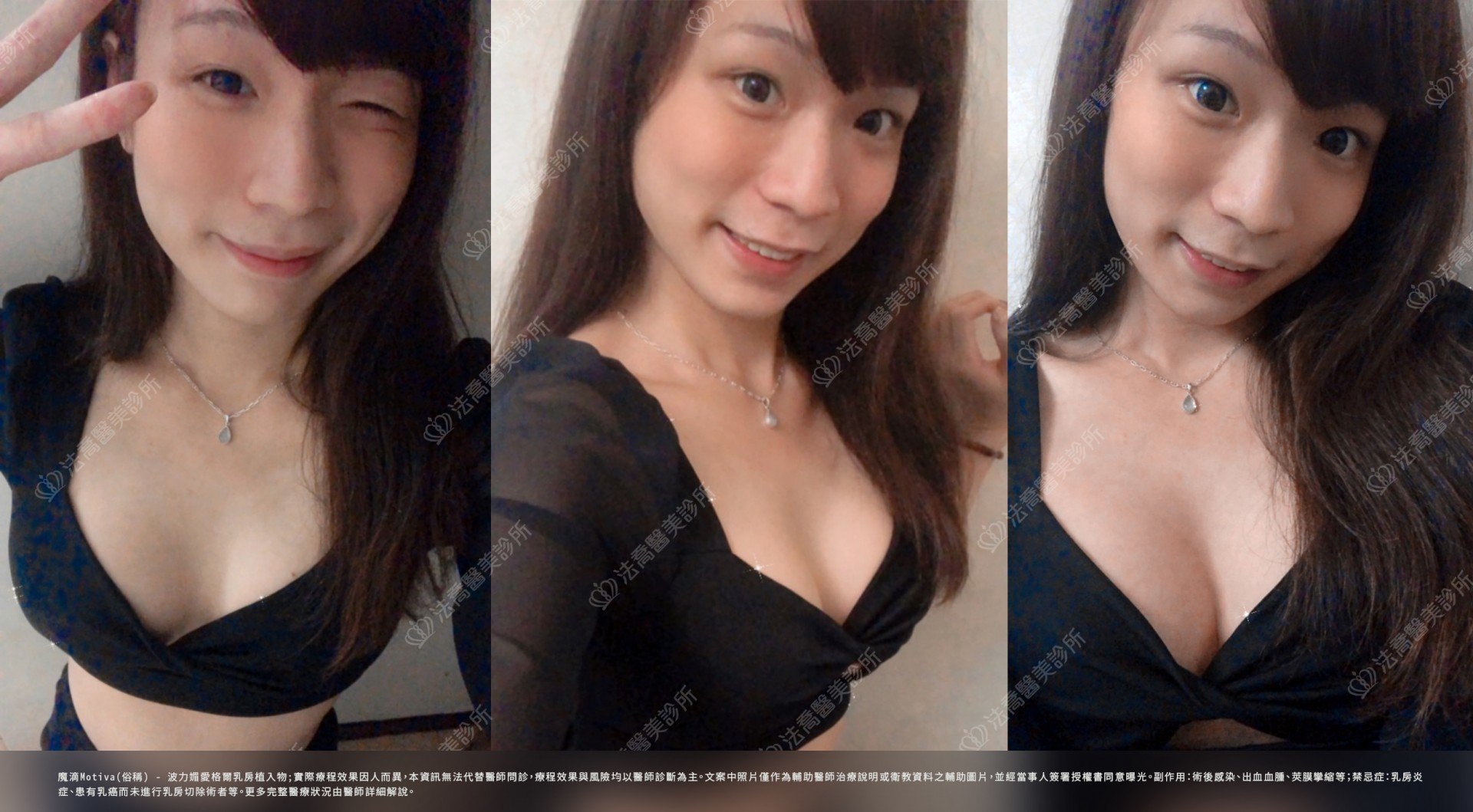 法喬醫美診所,邱浚彥,魔滴隆乳，自體脂肪豐胸