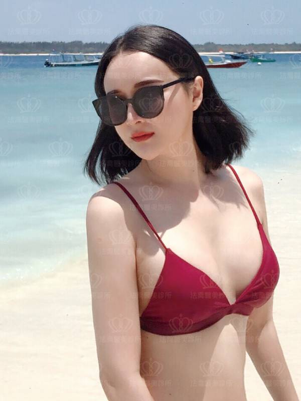 /files/images/案例分享/胸部【複合式隆乳】/陳怡珊(MICO)tug01_複合式圓型果凍矽膠隆乳/(術後1個月)陳怡珊(MICO)tug01_複合式圓型果凍矽膠隆乳2.jpg?1572249088 法喬醫美診所_複合式隆乳+威塑腹雕