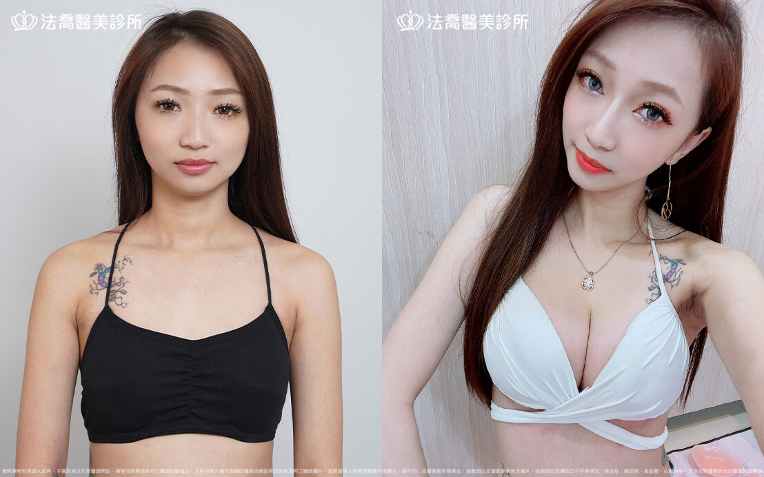 法喬醫美診所,邱浚彥,魔滴隆乳,隆乳推薦